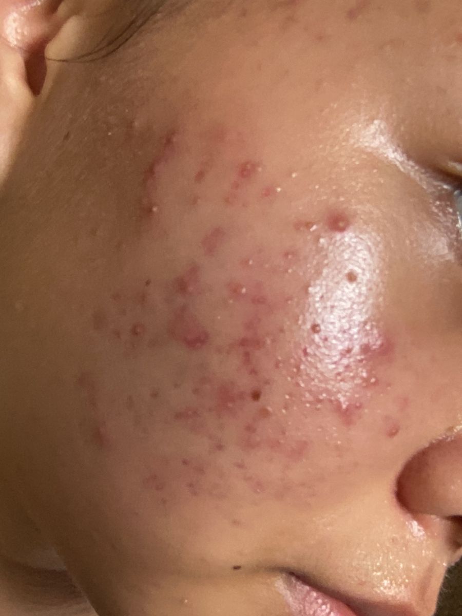 pimples.jpg